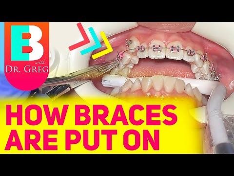 Getting Braces 101 - Putting Braces On