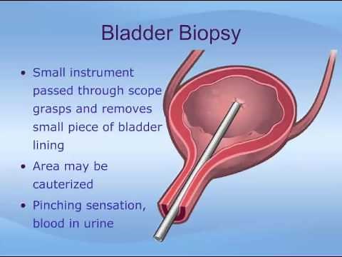 Cystoscopy