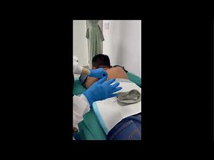 Back sebaceous cyst