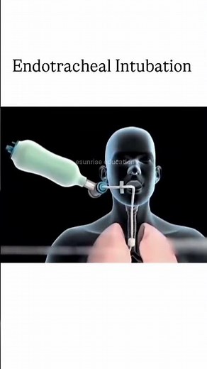 Endotracheal Intubation (Animated) | Medical Procedure for MBBS Students & Aspirants