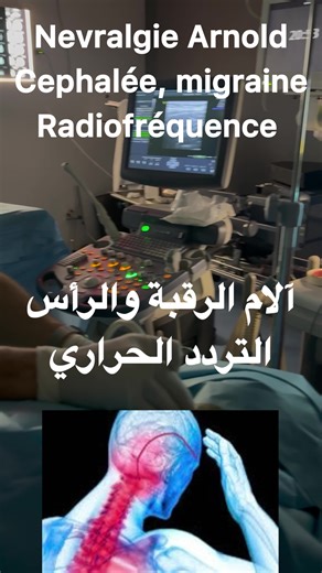 Réduire la Douleur avec la Radiofréquence Pulsée: Névralgie d'Arnold et Migraine