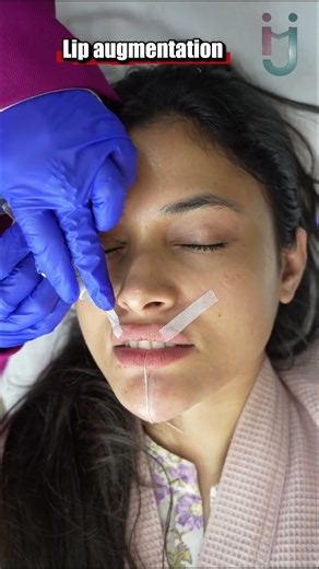 Lip Augmentation Procedure
