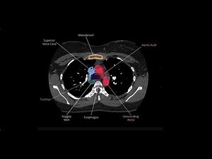 Chest Anatomy on actual CT Scan Simplified with Labels | Radiology Illustration