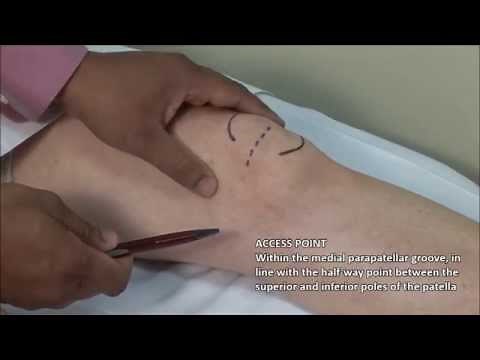 Knee Injection - Medial Approach