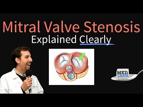 Mitral Valve Stenosis Explained Clearly - Pathophysiology, Symptoms, Treatment
