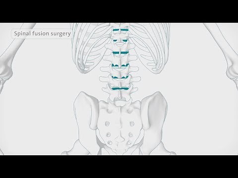How back surgery (spinal fusion) is performed | Spire Healthcare