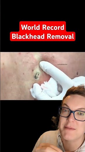 2025 Record BLACKHEAD REMOVAL - Stunning #shorts