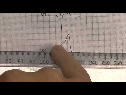 12 Lead EKG (ECG) STEMI examples