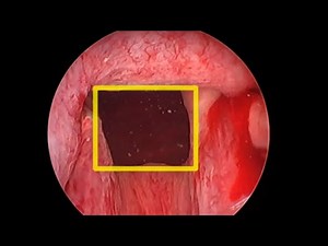 UroLift Box Technique