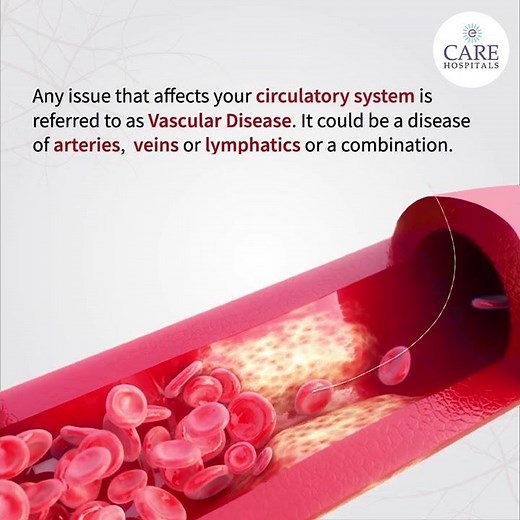 Introduction to Vascular Diseases | CARE Hospitals