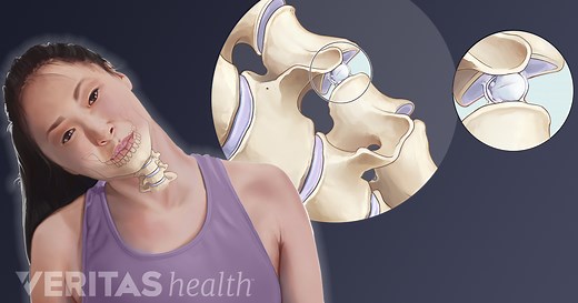 Neck Cracking and Grinding: What Does It Mean?