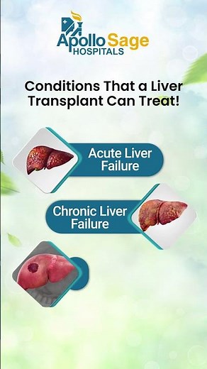 What is Liver Transplant? Consult Our Best Gastroenterologist - Apollo Sage Hospitals, Bhopal