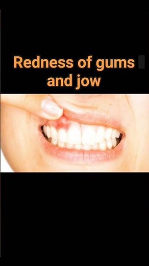 7 Signs of a Tooth Abscess | Dental Infection Symptoms | nursing airport NA