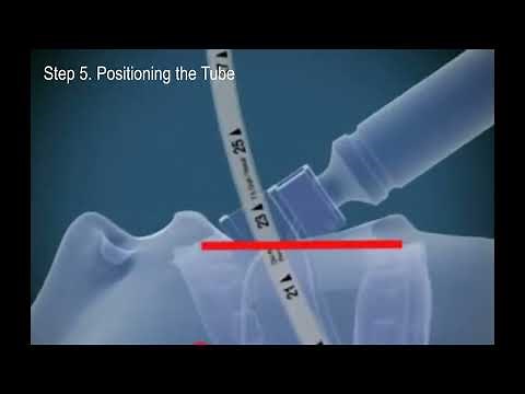 Endotracheal intubation: Step by step procedure