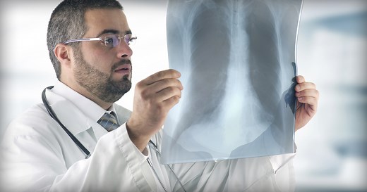 Radiation Therapy for Lung Cancer