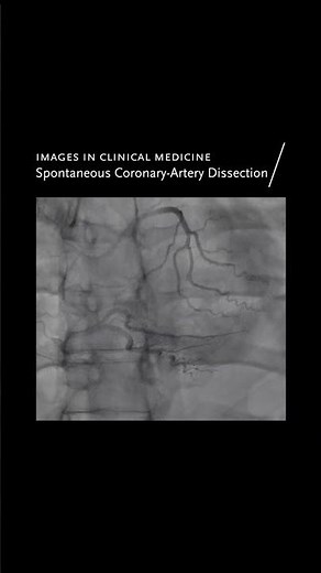 Images in Clinical Medicine: Spontaneous Coronary-Artery Dissection