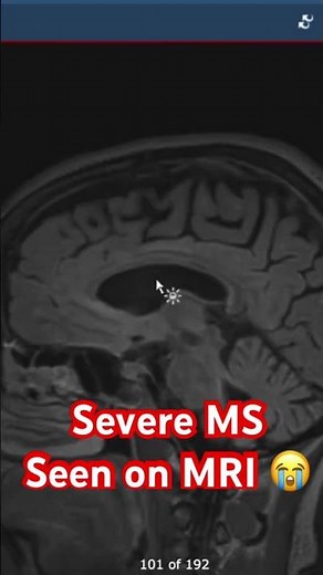 Severe MS seen on MRI 😭
