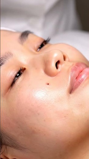 “Most Satisfying Blackhead Vacuum Session of the Year!”