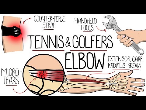 Understanding Tennis Elbow and Golfer's Elbow (Lateral & Medial Epicondylitis)