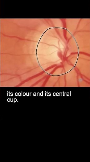 Examining the fundus – part 2 #ophthalmology