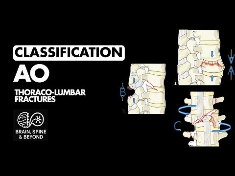 AO Classification Thoracolumbar Fractures