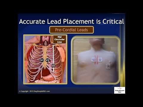 EKG Lead Placement