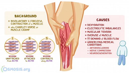 Muscle Spasms: What Are They, Causes, Diagnosis, and More | Osmosis
