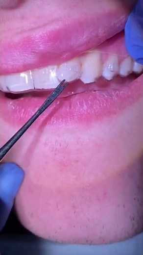 Getting your initial set of clear aligners / hybrid orthodontic / Tooth Time Family Dentistry NBTX