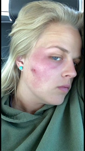 Dealing with MRSA from Popping a Pimple: My Experience