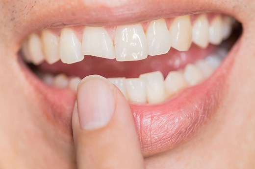 5 Dental Procedures to Repair Your Cracked or Broken Tooth