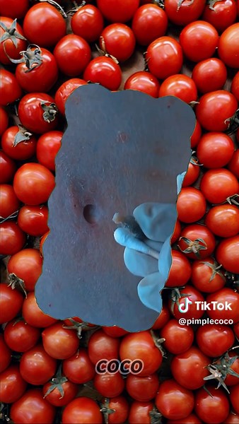 Cyst Popping Video: Watch Huge Pimples Bursting