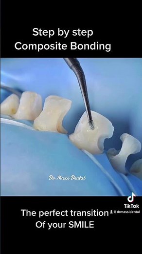 Teeth Composite bonding step by step