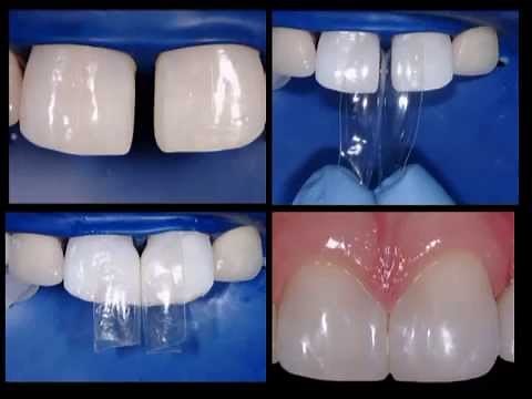 Bioclear - Diastema Closure