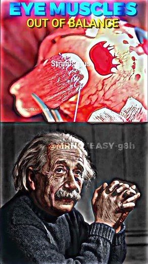 How Strabismus Eye Surgery Works | Eye Alignment Explained