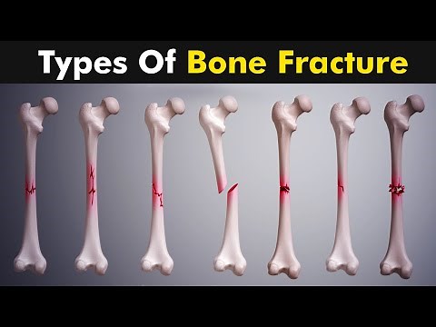 Common types of Bone fracture | 3D animation |