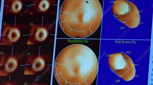 Heart MUGA scan footage, nuclear imaging - Stock Video Clip - K005/3510