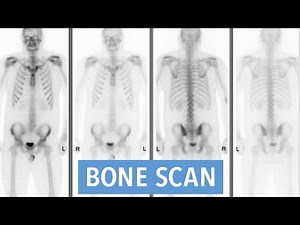 Introduction to the Bone Scan (Bone Scintigraphy)