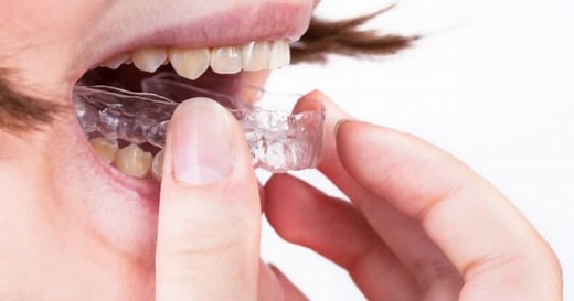 Essix Retainer: Cost, Cleaning, Care and Pros and Cons - Dentaly.org