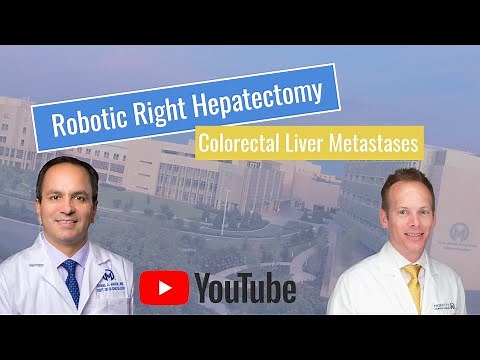 Robotic Right Hepatectomy following Portal Vein Embolization for Colorectal Liver Metastases