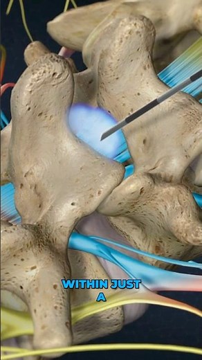 Lumbar Epidural Steroid Injection (3D Animation)