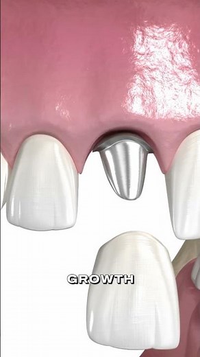 When There’s Not Enough Bone for Dental Implant