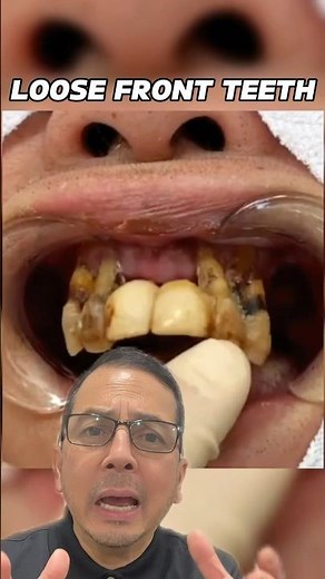 Dentist Explains The BEST Time to Remove Loose Front Teeth | View Mobile Dental #shorts