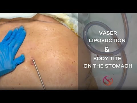 Vaser Liposuction and BodyTite on the Stomach | Dr. Shalini Gupta