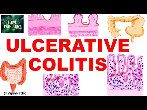 Ulcerative Colitis Explained | Pathogenesis, Morphology & Pathology